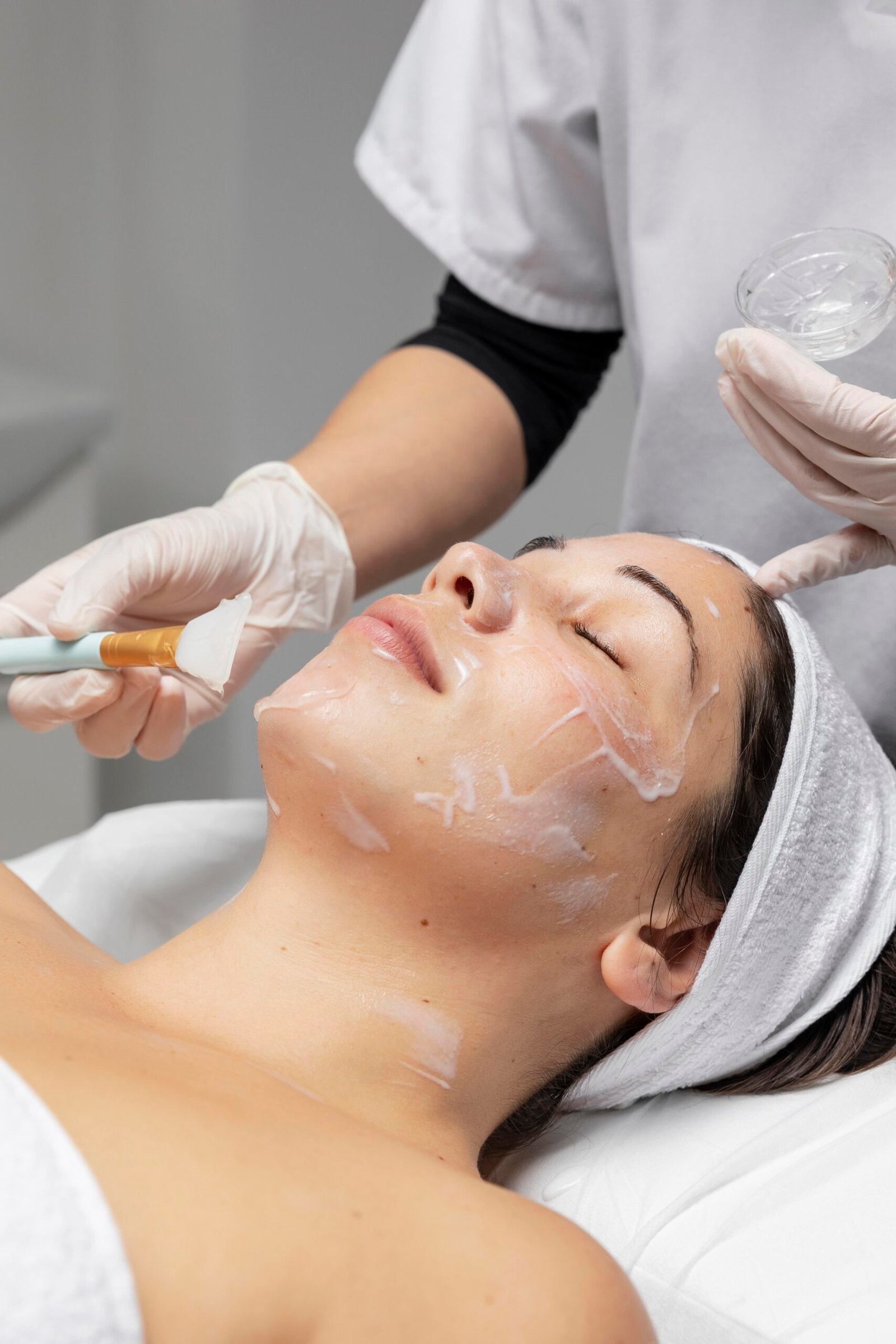 chemical peel