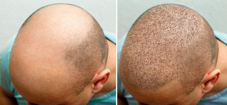 hair transplant website