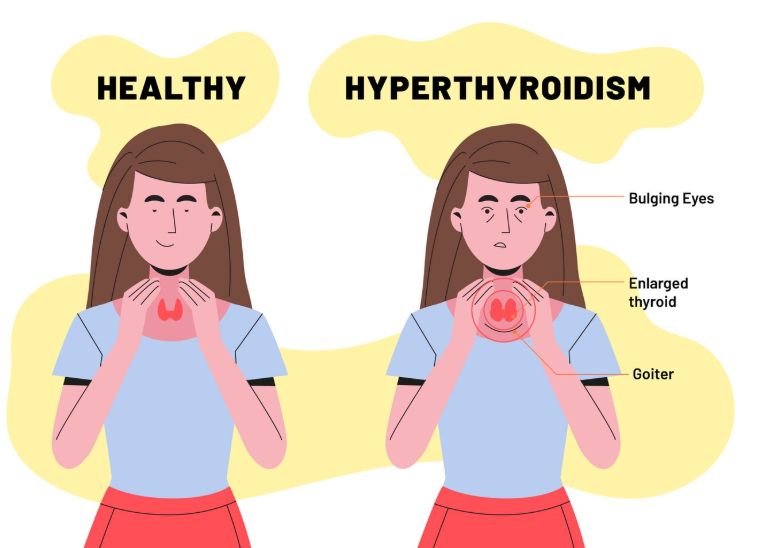 Hyperthyroidism