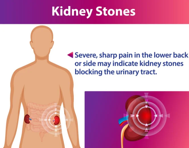 Kidney Stone