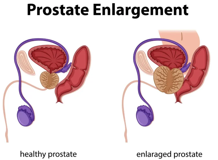 Prostate Enlargement (BPH)