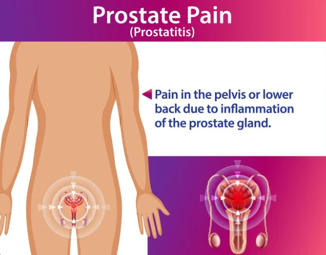 Prostatitis