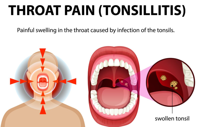 Tonsils